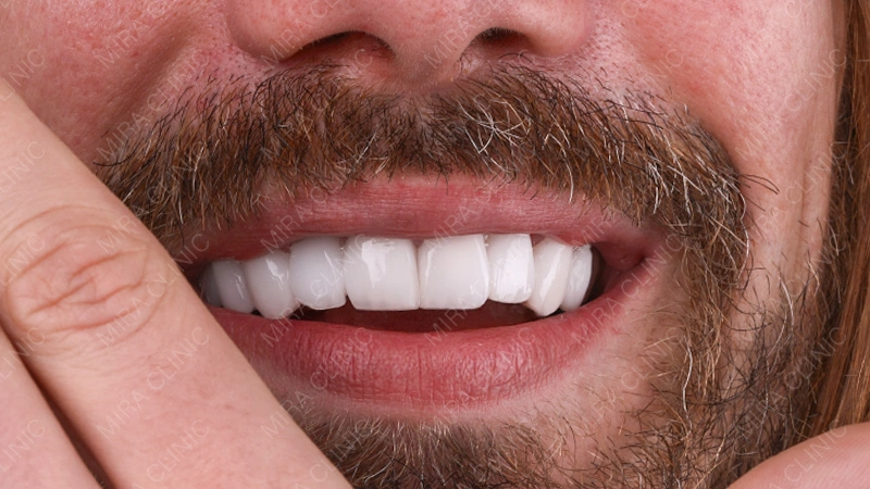 enamel preservation veneers